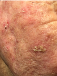 PicturePicture of actinic keratosis on right cheek