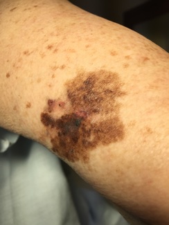 Picture of Melanoma on arm