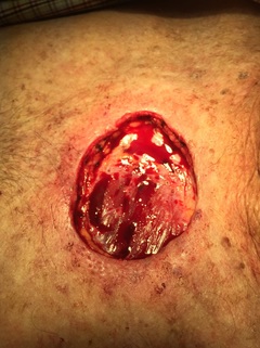 Picture of After Surgical Removal of Squamous Cell Carcinoma of the Skin