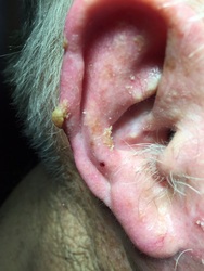 Picture of actinic keratosis on the right ear