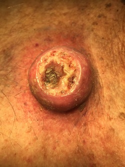 Picture of Squamous Cell Carcinoma of the Skin, Keratoacanthoma type